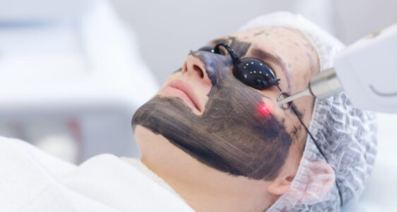 Carbon Laser Peel